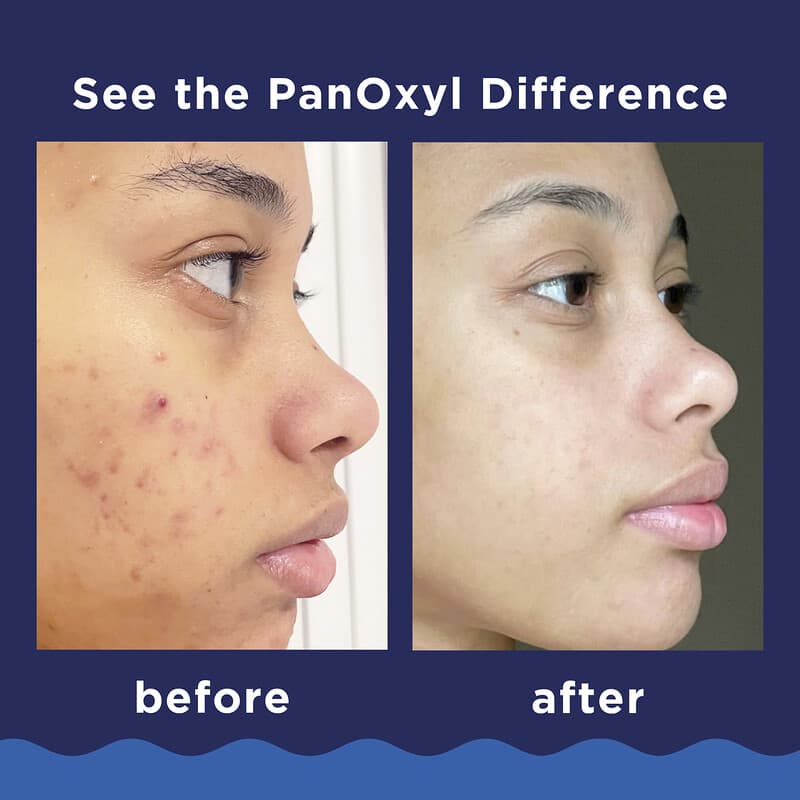 PanOxyl, Nettoyant moussant contre l'acné pour le visage et le corps, Efficacité maximale, 85 g